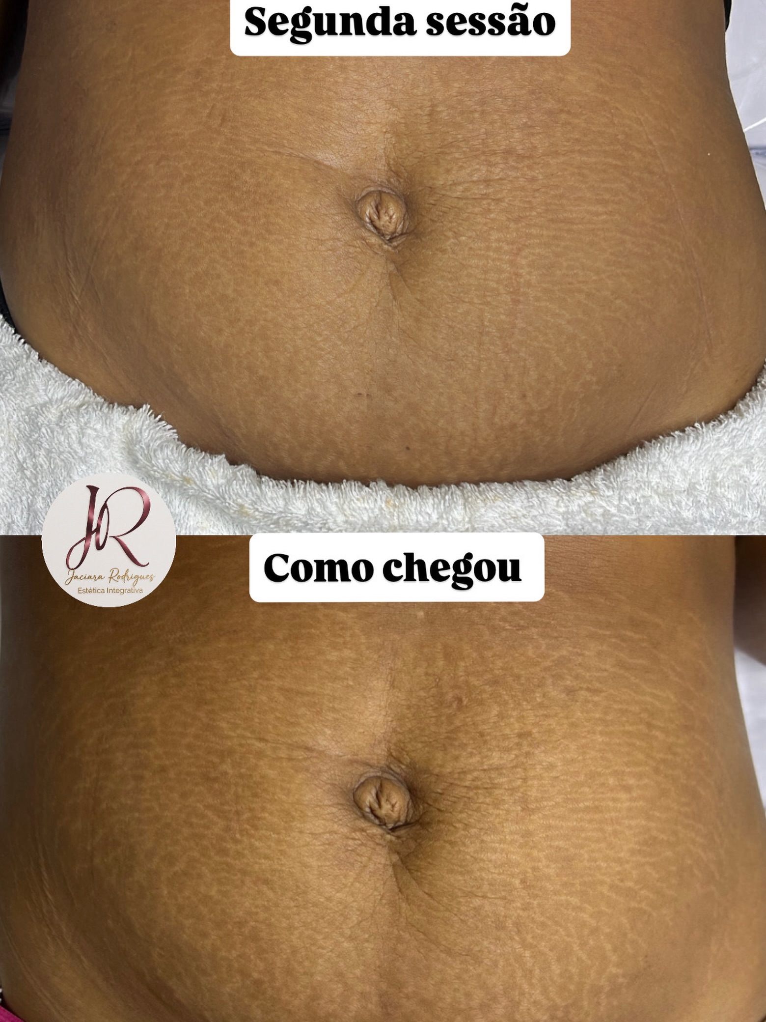 Evolução da região abdominal ao longo das sessões do Método SaraEstrias